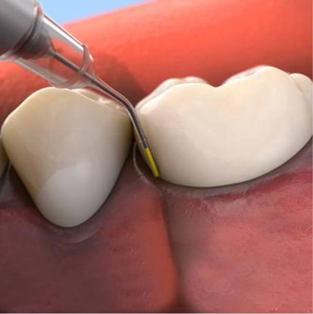 Animated smile during topical antibiotic therapy treatment