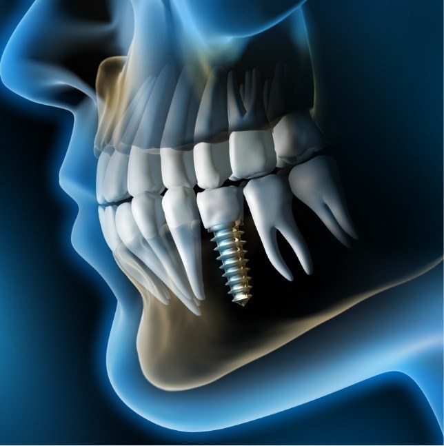Animated smile with dental implant