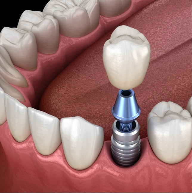 Crown being placed on dental implant