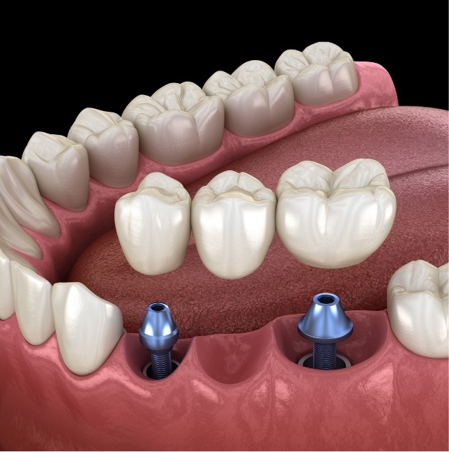 Bridge being placed on two dental implants