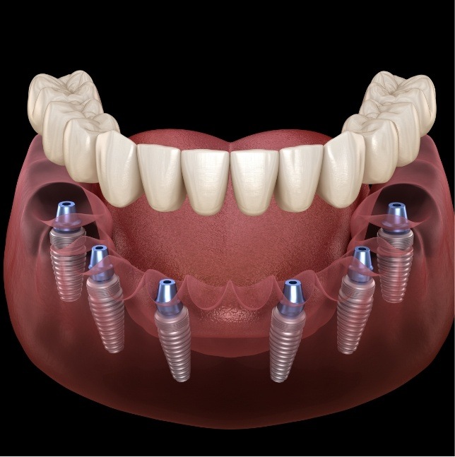 Full denture being placed on six dental implants