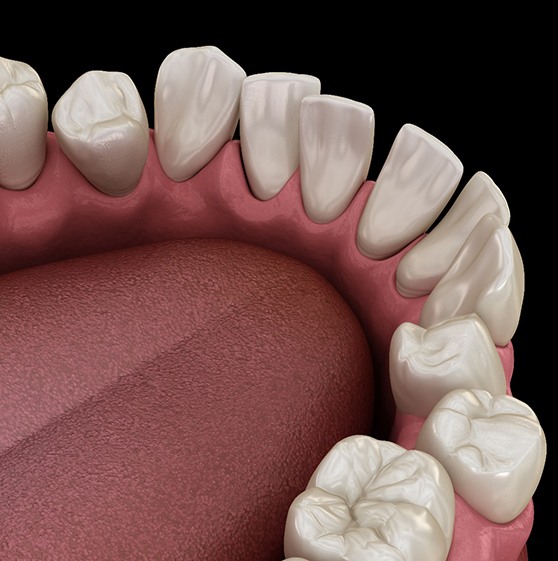 illustration of row of crooked teeth