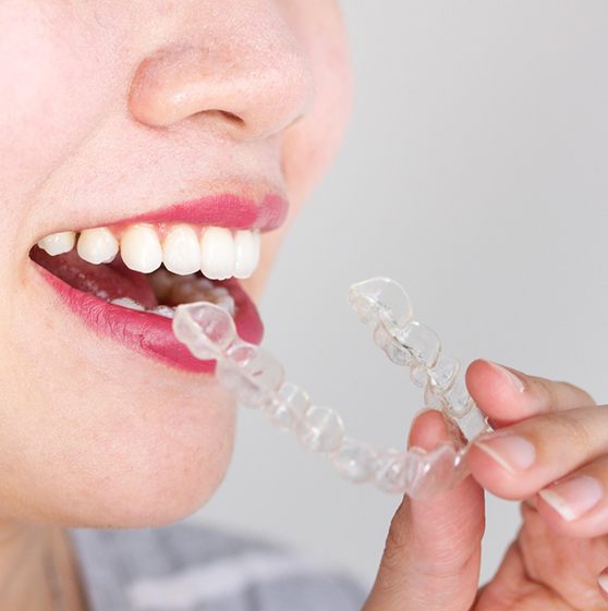 Person placing clear aligner in their mouth