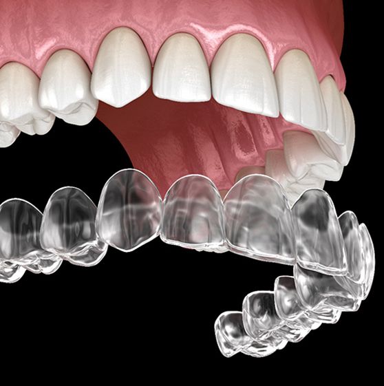 Illustrated clear aligner being placed over row of teeth