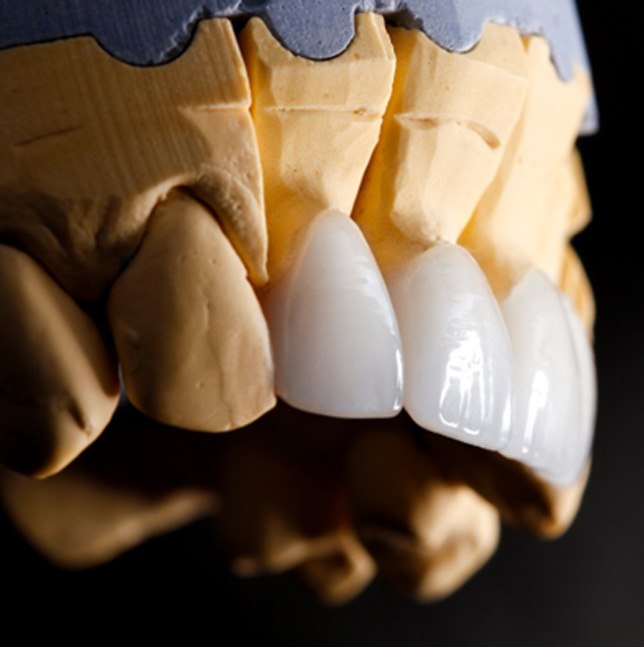 dental veneers on a plaster model of a mouth